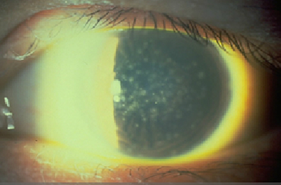 keratit – Lens Dünyası