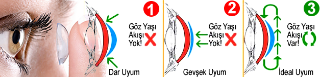lens kuruluk nedenleri